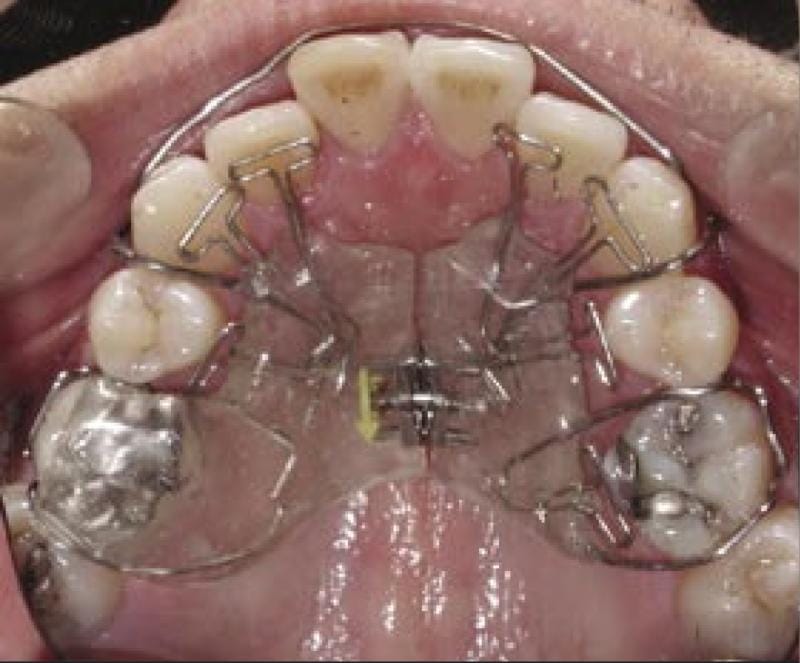 Homeoblock UK: A Revolutionary Approach to Facial Development and Palatal Expansion
