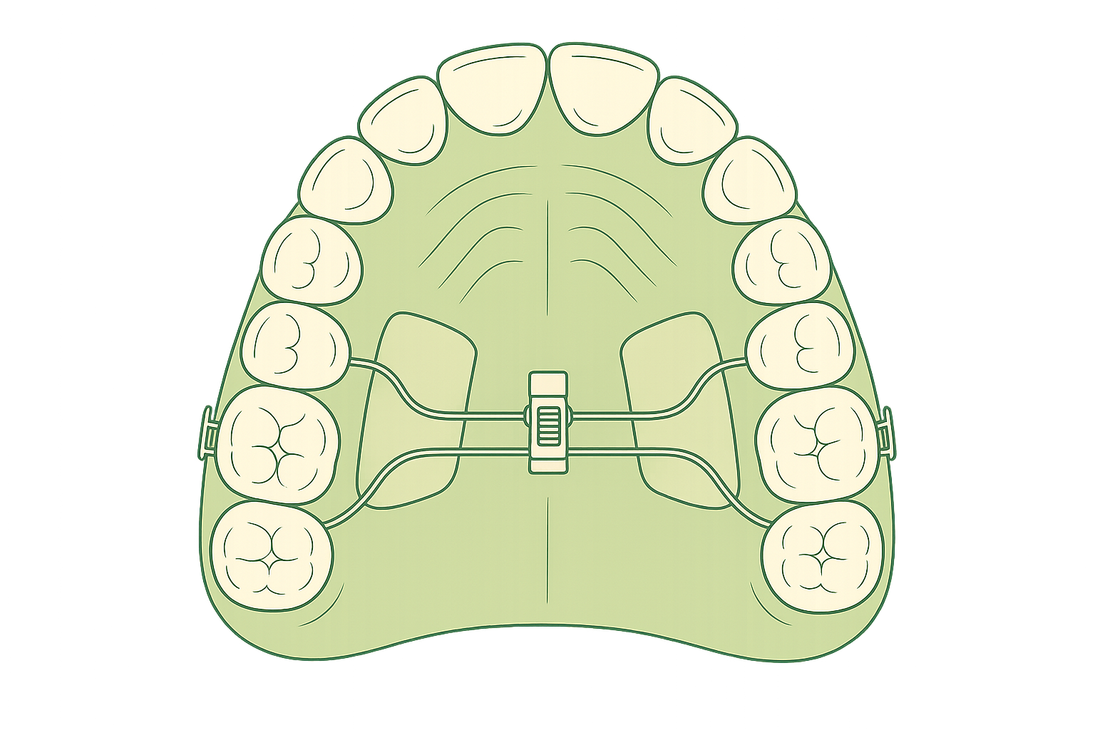 Line illustration of a removable acrylic upper plate appliance with an expansion screw